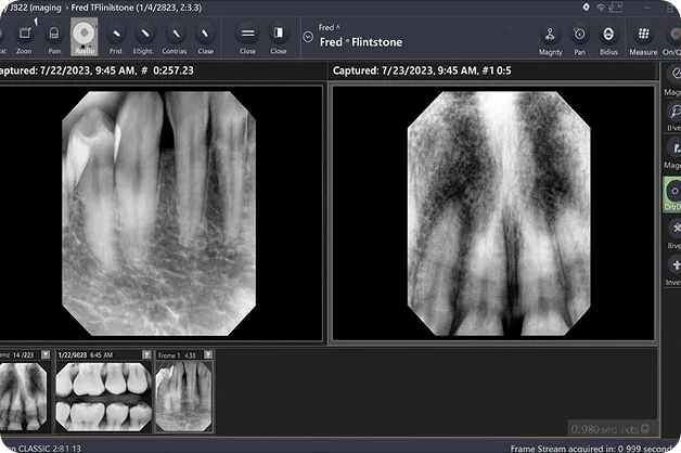 Periapical dental X-ray showing adult anterior teeth roots and surrounding bone structure for clinical diagnosis